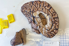 A donated brain specimen sits on a white table top in a lab. It has been sliced in half for a research autopsy. 